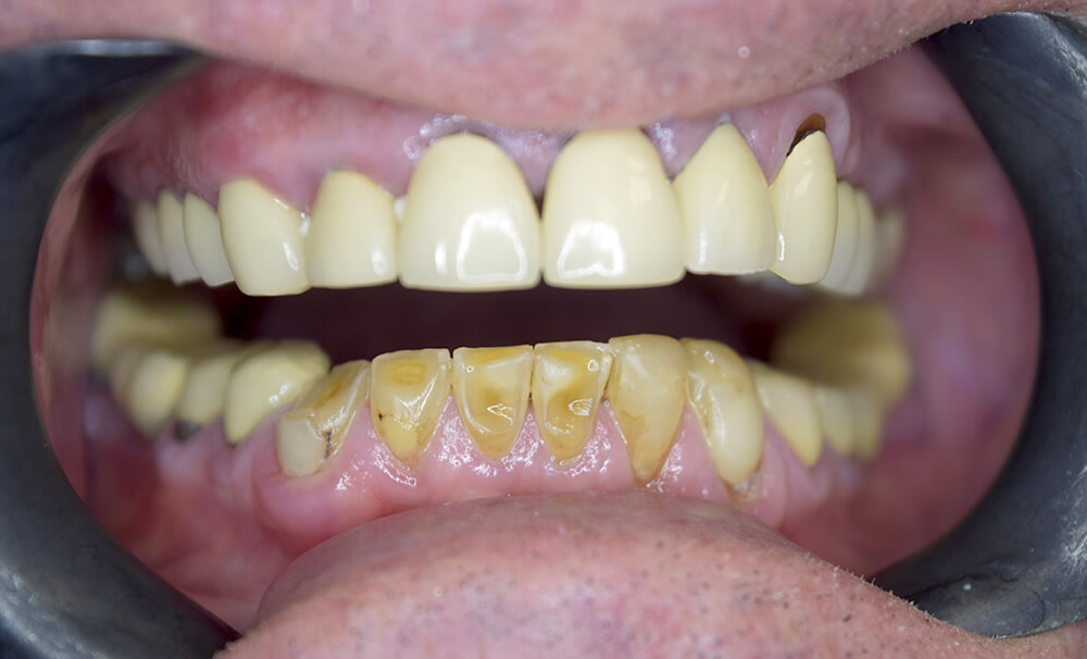 Before picture of Dental Crowns