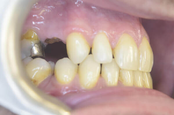 Gap after extraction