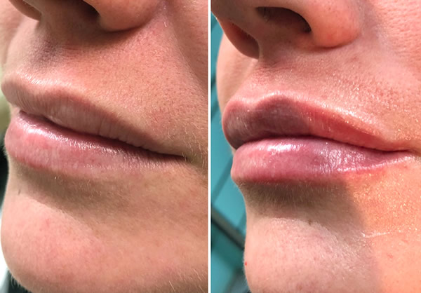 Lip Fillers at Stockport dentist Charisma Clinic