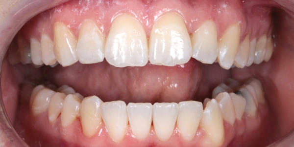 Patient after Invisalign Stockport