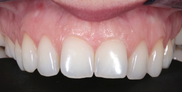 Before Patient composite bonding case study Manchester