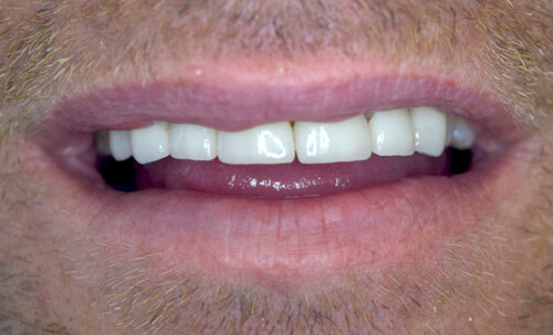 After crowns & veneers treatment