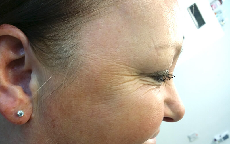 Crow's feet after Botox treatment near me