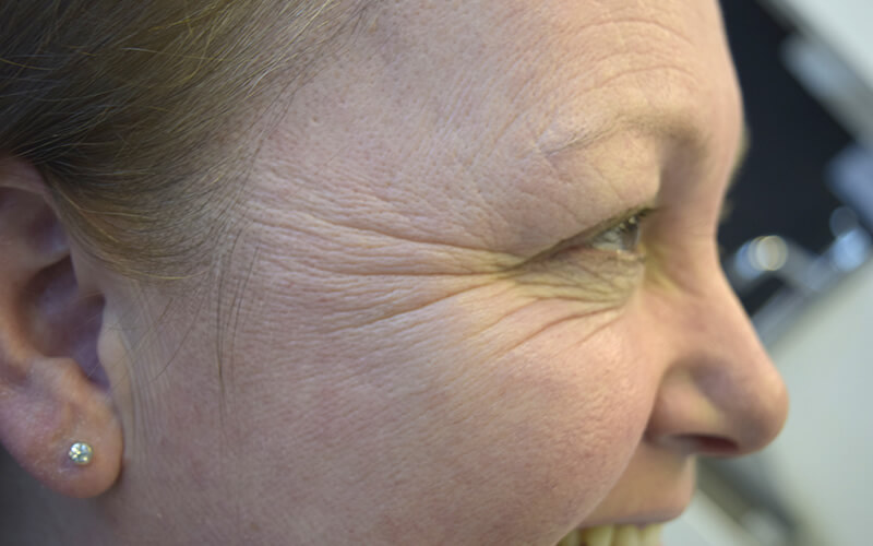 Crow's feet before anti wrinkle treatment