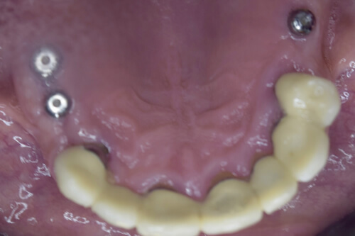 Dental implant upper arch
