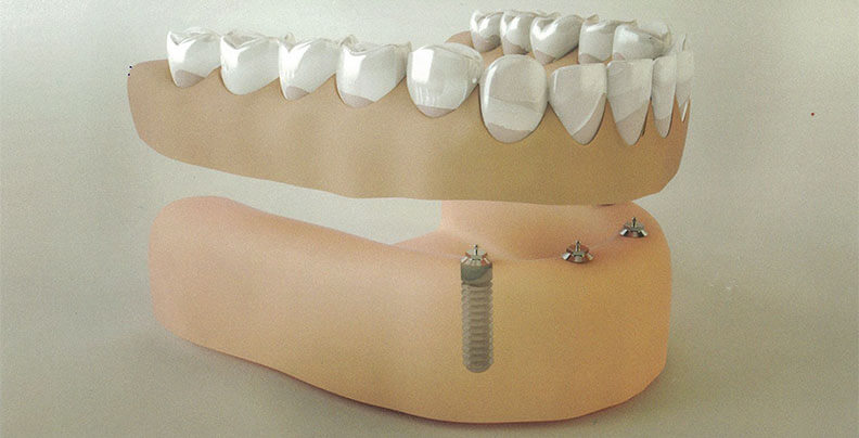 Implant Dentures in Stockport