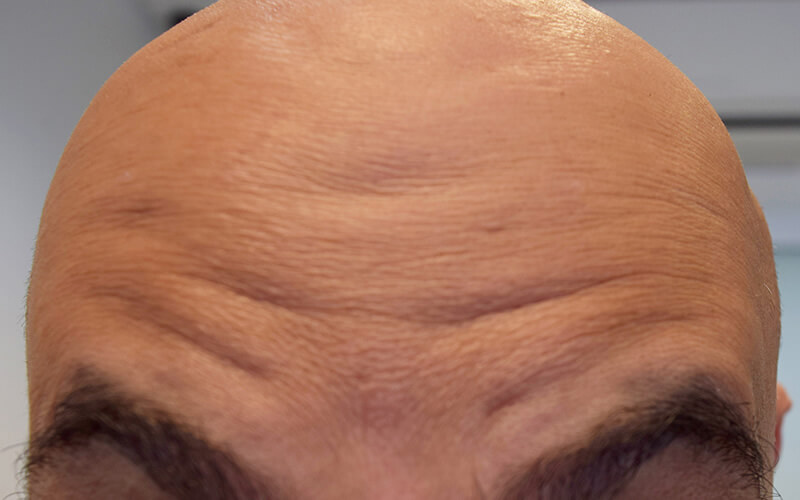 Forehead before anti wrinkle injection in Burnley