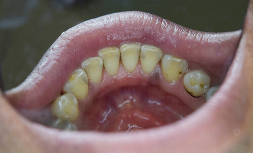 Poor oral hygiene with heavy staining after treatment