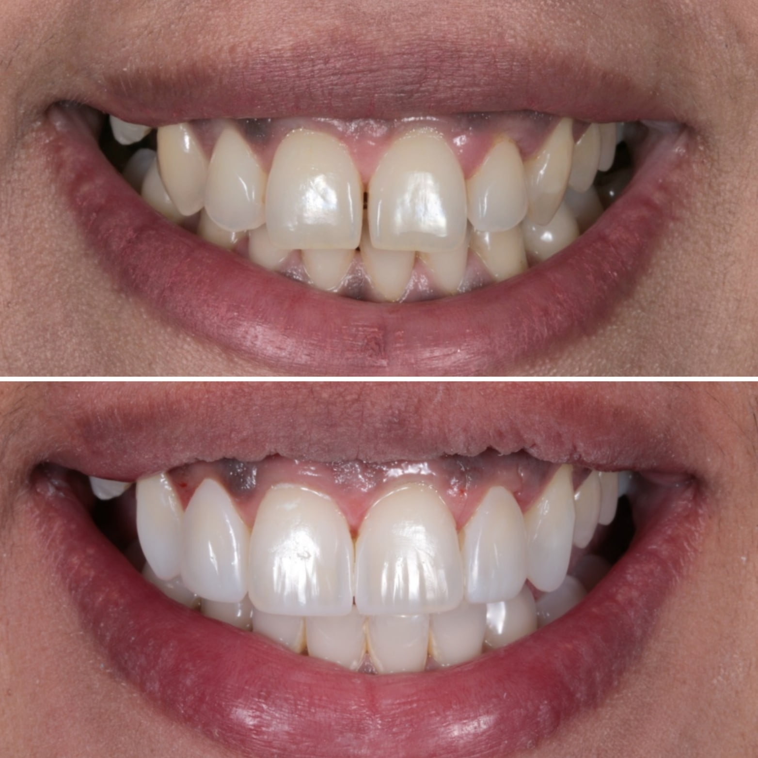 A new Invisalign patient at Charisma Clinic Stockport
