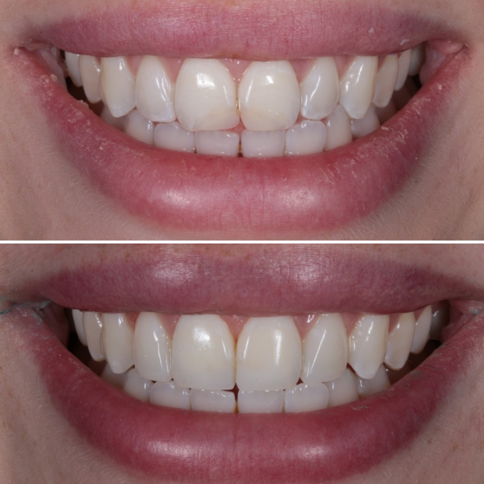 Invisalign braces at Charisma Clinic Stockport