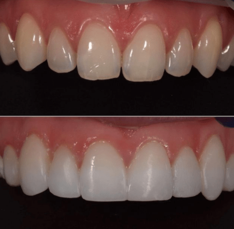 More stunning Invisalign results at Charisma Clinic Stockport
