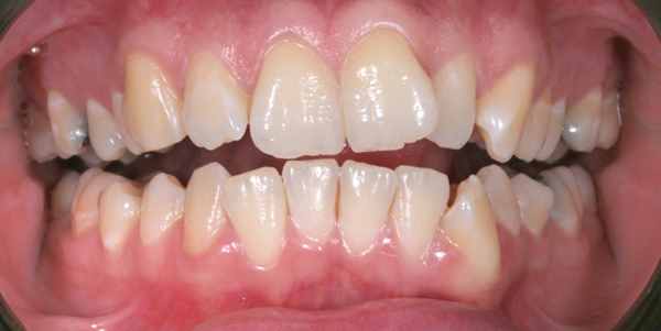 Patient before Invisalign in Stockport