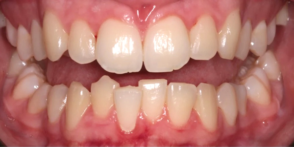 Patient before Invisalign at Charisma Clinic Stockport
