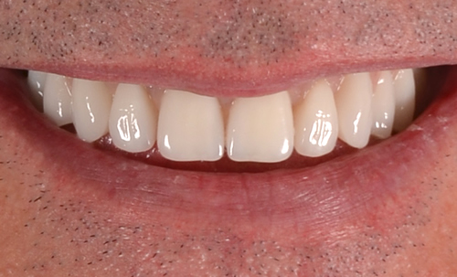 Patient after Same day teeth in Burnley