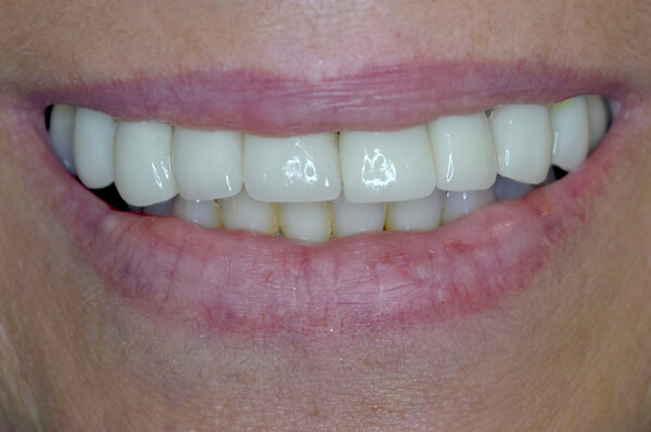 After Smile Makeover with Veneers