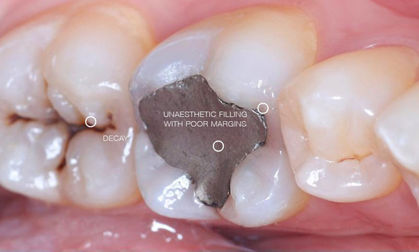 Before white fillings at Charisma clinic in Stockport