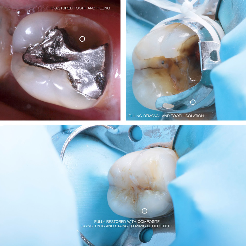 Tooth onlay repair with cosmetic bonding