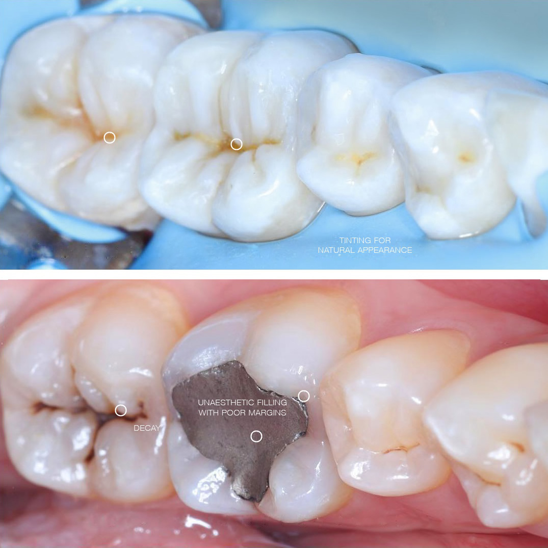 White fillings and wisdom teeth repair in Stockport