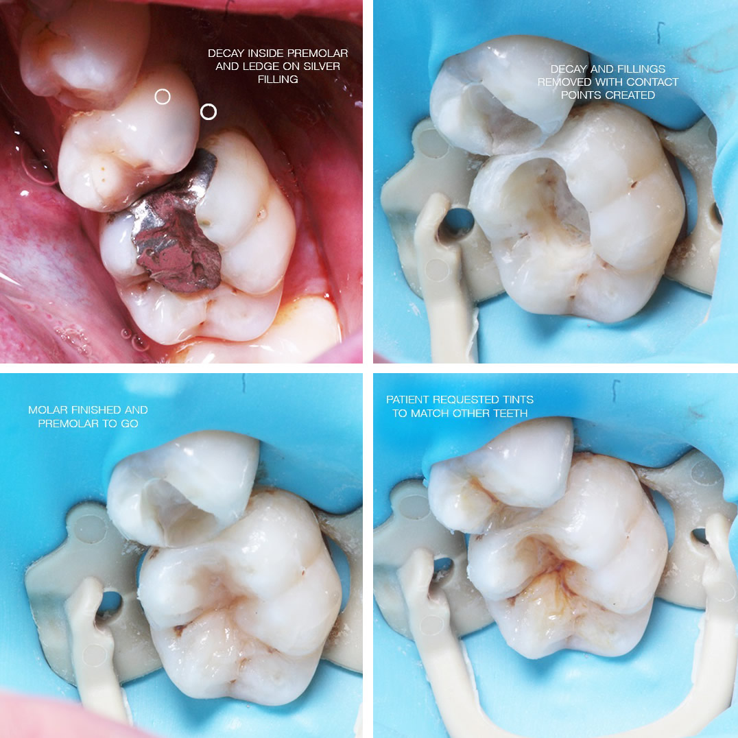 Tooth molar repair with cosmetic bonding