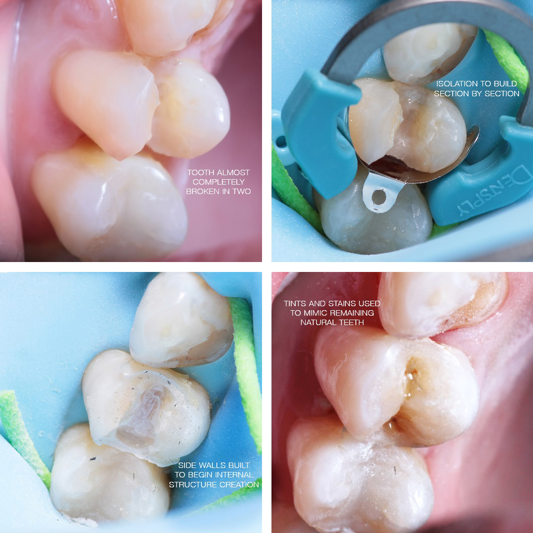 Tooth repair with cosmetic bonding