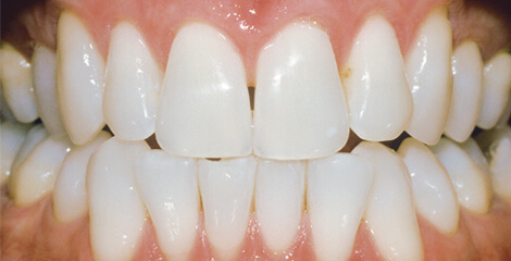Stockport Teeth Whitening Before