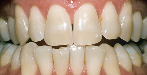 laser Teeth Whitening Stockport results