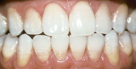 Stockport Teeth Whitening After