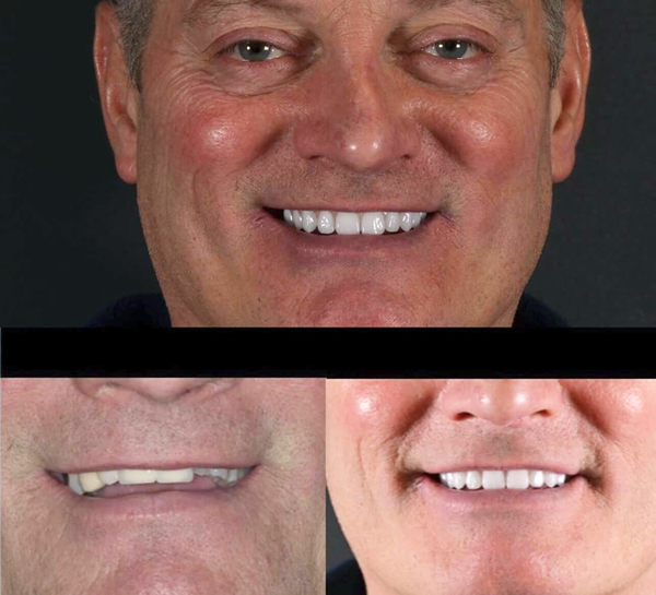 Same day teeth patient at Charisma in Stockport