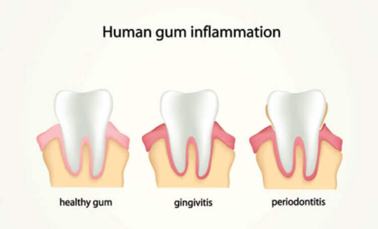Gum disease symptoms