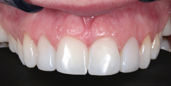 After Patient composite bonding near me case study