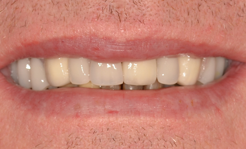 Patient after Crowns & Bridges in Burnley