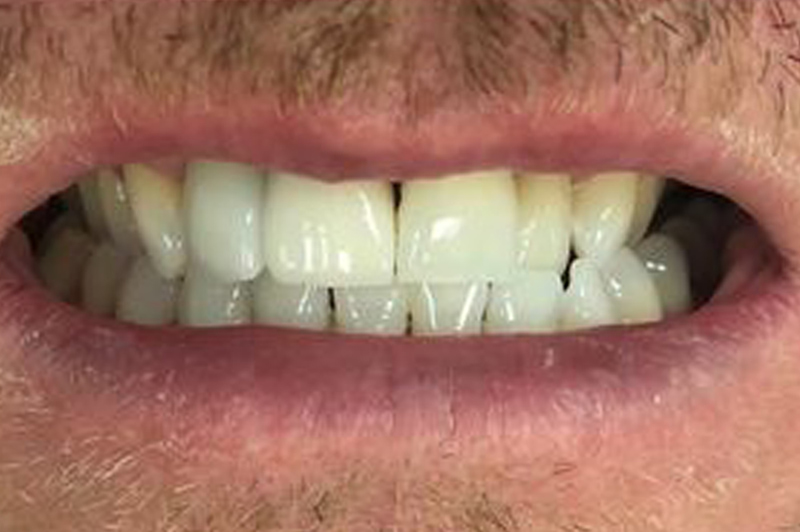 After dental implant in Burnley