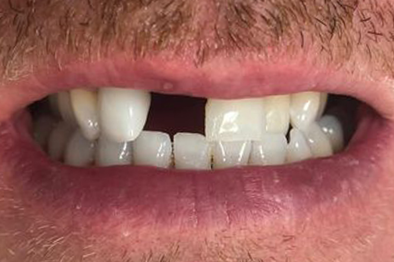 Before dental implant in Burnley