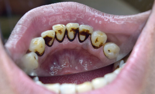 Poor oral hygiene with heavy staining before teeth cleaning