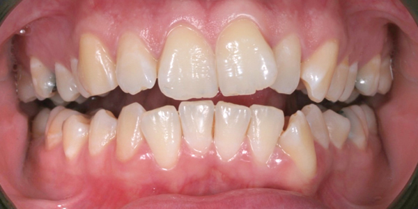 Patient before Invisalign in Burnley