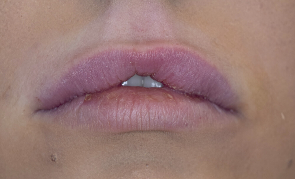 After dermal lip filler Burnley