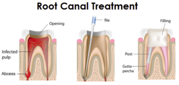 Root Canal Before and After Burnley